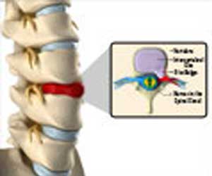 Discectomy - Types, Preparation, Procedure, Risk & Complications