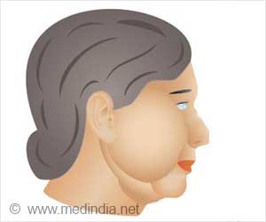 Facelift Rhytidectomy Surgical Procedures