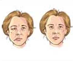 Facial Nerve Decompression