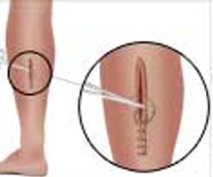 Fasciotomy - Surgical Procedure