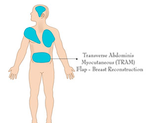 Flap Surgery - Types, Tests, Procedures and Complications
