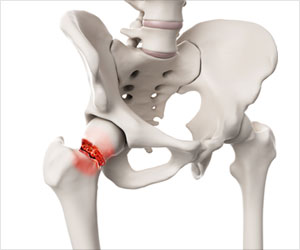 Fracture Neck of Femur - Risk factors, Types, Causes, Complications Management, Prognosis
