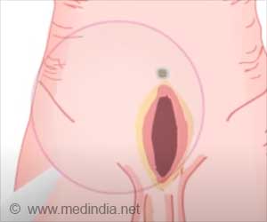 Incisional Hernias | Causes | Symptoms | Diagnosis | Surgery | Complications
