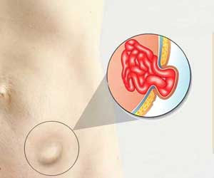 Inguinal Hernia Surgery | Inguinal Hernia Repair