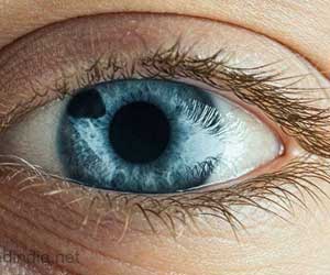 Iridectomy | Iridotomy - Types, Risks, Complications & Prognosis