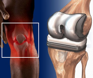 Knee Replacement Surgery–Total Replacement–Partial Replacement-Complications