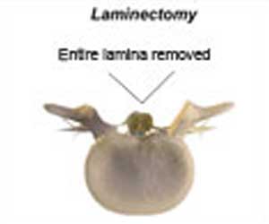Laminectomy - Types, Procedure, Recovery, Risks