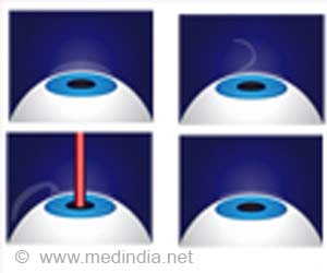 LASIK Eye Surgery
