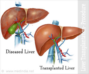 Liver Transplantation Part 1: Procedure and Techniques