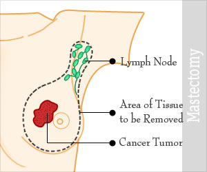 Mastectomy - Types, Risks, Preparation