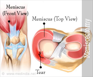 Meniscectomy - Types, Treatment, Risk, Recovery, Tips