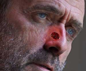 Mohs Surgery for Skin Cancer - Advantages, Risks & Complications