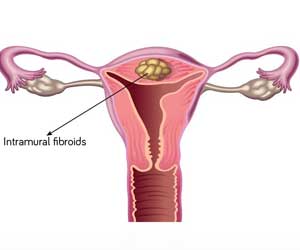 Myomectomy - Indications, Types, Preparation, Procedure & Complications