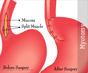 Myotomy - Achalasia Cardia, Procedures, Techniques, Complications