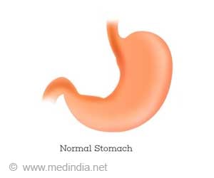 Nissen fundoplication - Indications, Types & Risks