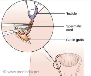 Orchidectomy | Orchiectomy - Types, Indications, Risks and Complications