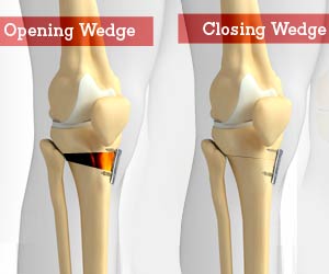 Osteotomy - Types, Risks & Complications