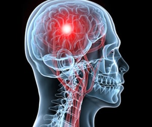 About Parkinson's Disease