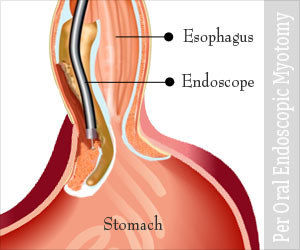 Per Oral Endoscopic Myotomy (POEM)