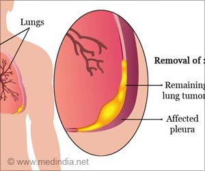 Pleurectomy - Types, Risks & Complications