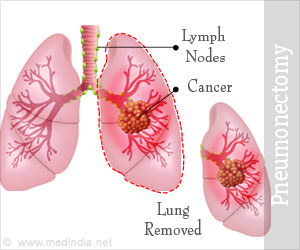 Pneumonectomy - Types, Tests, Preparation, Potential Complications