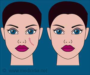 Scar Revision - Cosmetic Surgery