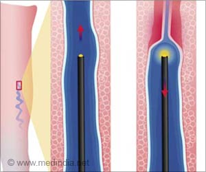 Sclerotherapy - A Treatment for Varicose Veins