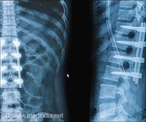Spinal Fusion - Types, Risks, Complications & Prognosis