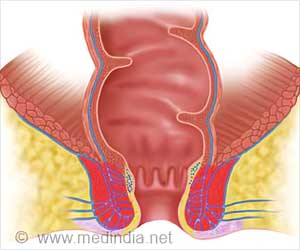 Piles / Hemorrhoids - Surgical options