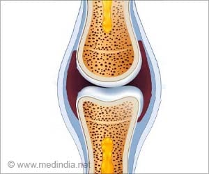 Synovectomy - Types, Risks & Complications