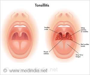 About Tonsillectomy