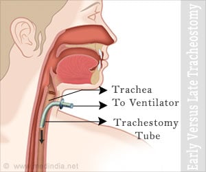 About Tracheostomy