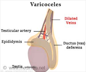 Varicocele