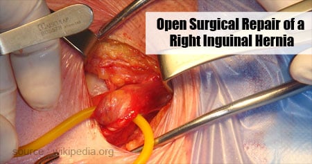 Right Inguinal Hernia Repair (Male Patient) 