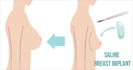 Breast Augmentation Surgery - Types, Indications, Surgical