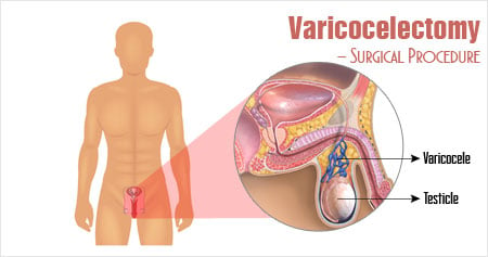 Microsurgical Subinguinal Varicocele Repair. A) Incision sites commonly