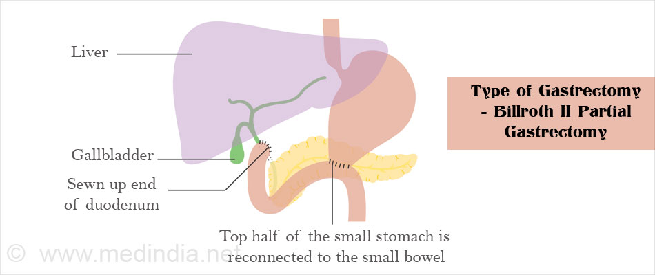 Type of Gastrectomy - Billroth II Partial Gastrectomy Type of Gastrectomy - Billroth II Partial Gastrectomy