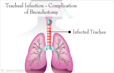 Infected Trachea Infected Trachea