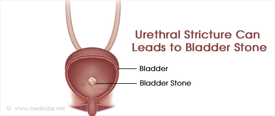 Urethral Stricture Causes Symptoms Complications Diagnosis Treatment