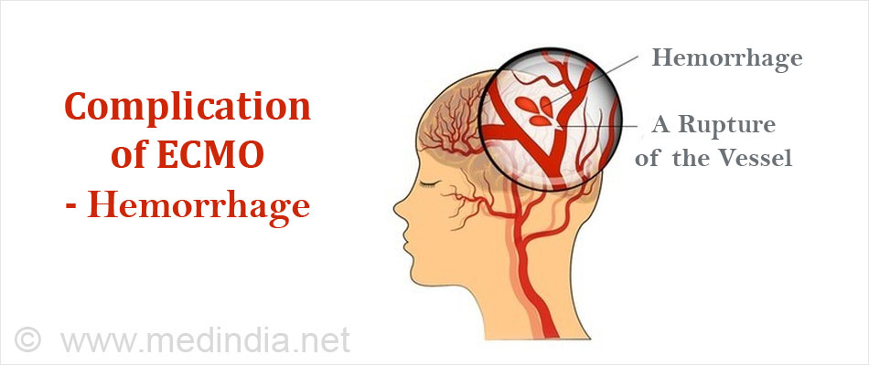 Complication of ECMO - Stroke Complication of ECMO - Stroke