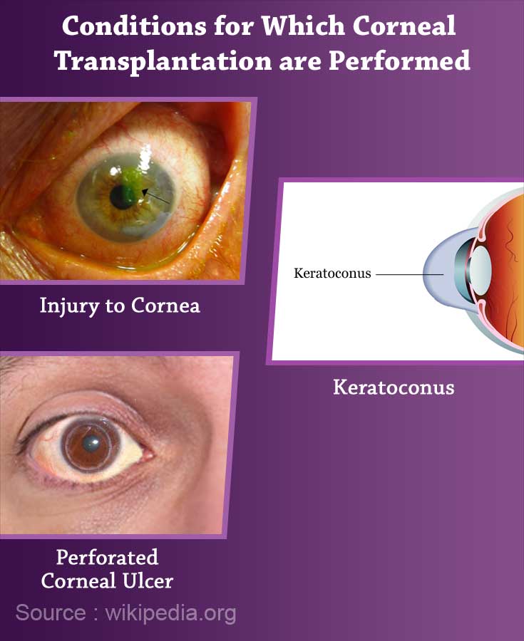 Conditions for which Corneal Transplantation is Performed Conditions for which Corneal Transplantation is Performed