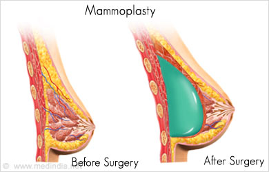 Cosmetic Surgery Cosmetic Surgery