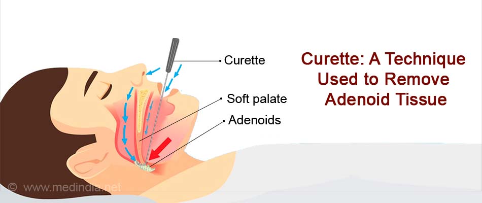 Adenoidectomy Indications Preparation Procedure Complications