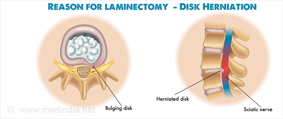 Reason for laminectomy - Disk Herniation Reason for laminectomy - Disk Herniation