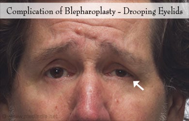 Drooping Eyelid Drooping Eyelid