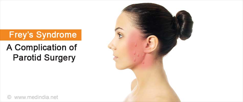 Frey's Syndrome: A Complication of Parotid Surgery Frey's Syndrome: A Complication of Parotid Surgery