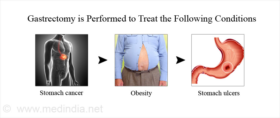Gastrectomy is Performed to Treat the Following Conditions Gastrectomy is Performed to Treat the Following Conditions