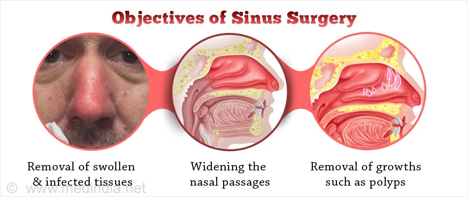 Types Of Sinus Surgery In India