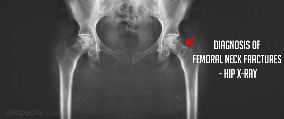 Fracture Neck of Femur - Risk factors, Types, Causes, Complications ...