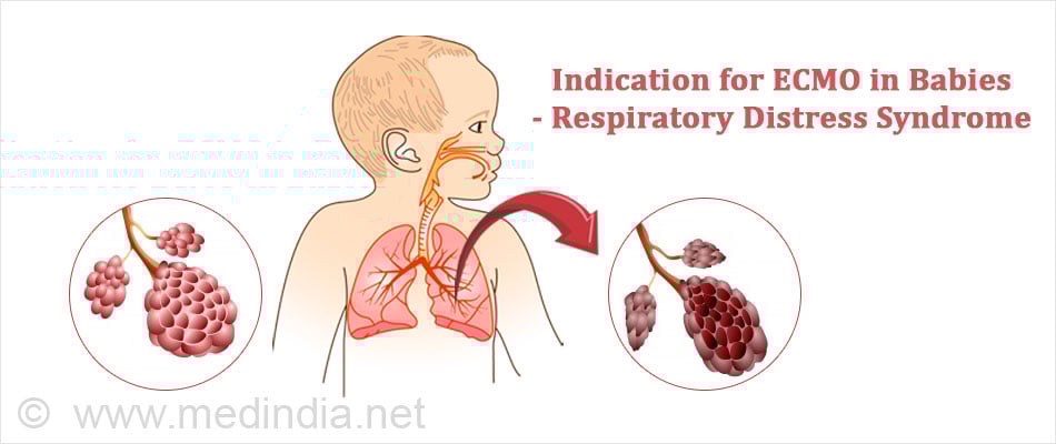 Indication for ECMO in Babies - Respiratory Distress Syndrome Indication for ECMO in Babies - Respiratory Distress Syndrome